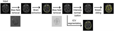 Brain volume is a better biomarker of outcomes in ischemic stroke compared to brain atrophy